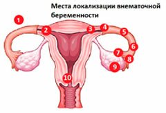 Внематочная беременность: места локализации