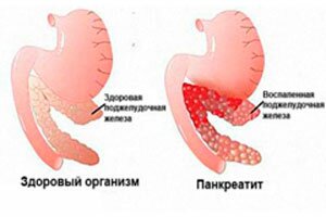 Здоровая поджелудочная железа и поражённая панкреатитом