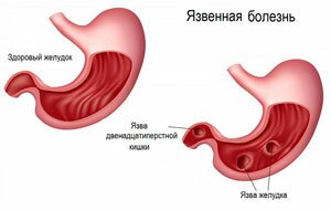 Здоровый желудок и поражённый язвой