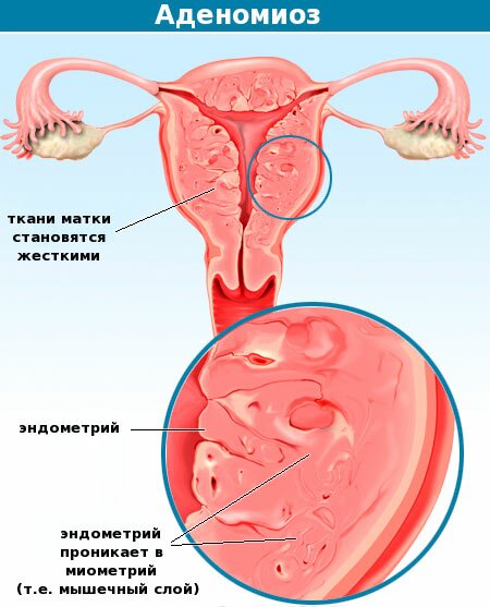 Аденомиоз