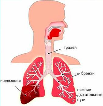 Пневмония у человека