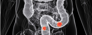 рентгеноскопия толстого кишечника