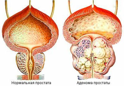 Нормальная простата и больная