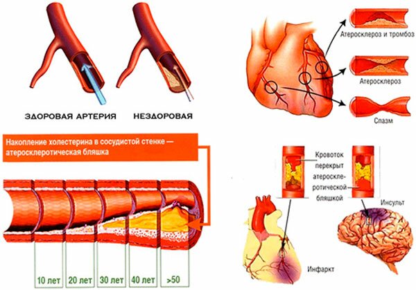 Фактор атеросклероза в ишемической болезни сердца