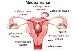Газы во время менструации